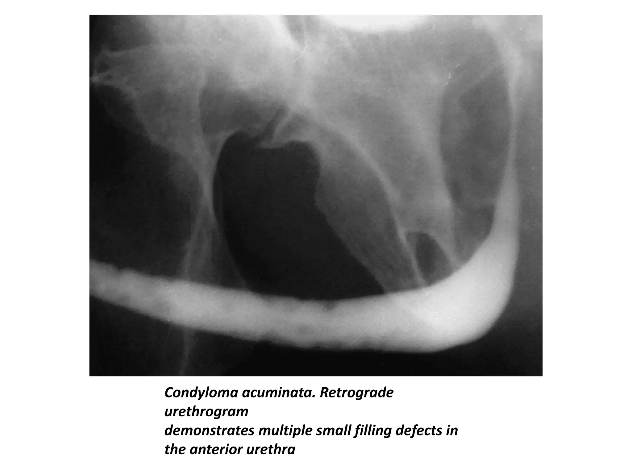 Condyloma acuminata. Retrograde
urethrogram
demonstrates multiple small filling defects in
the anterior urethra
 
