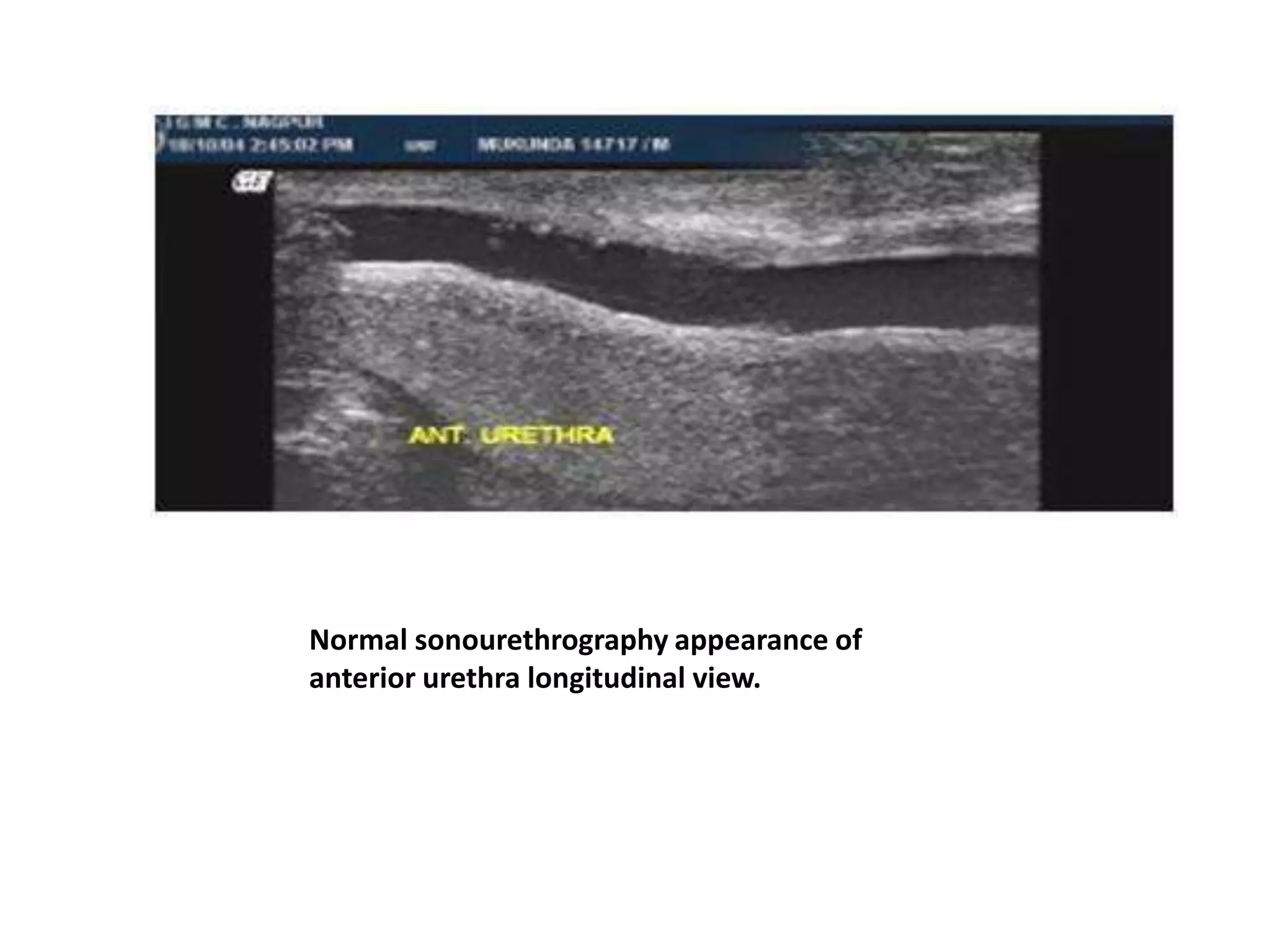 Normal sonourethrography appearance of
anterior urethra longitudinal view.
 