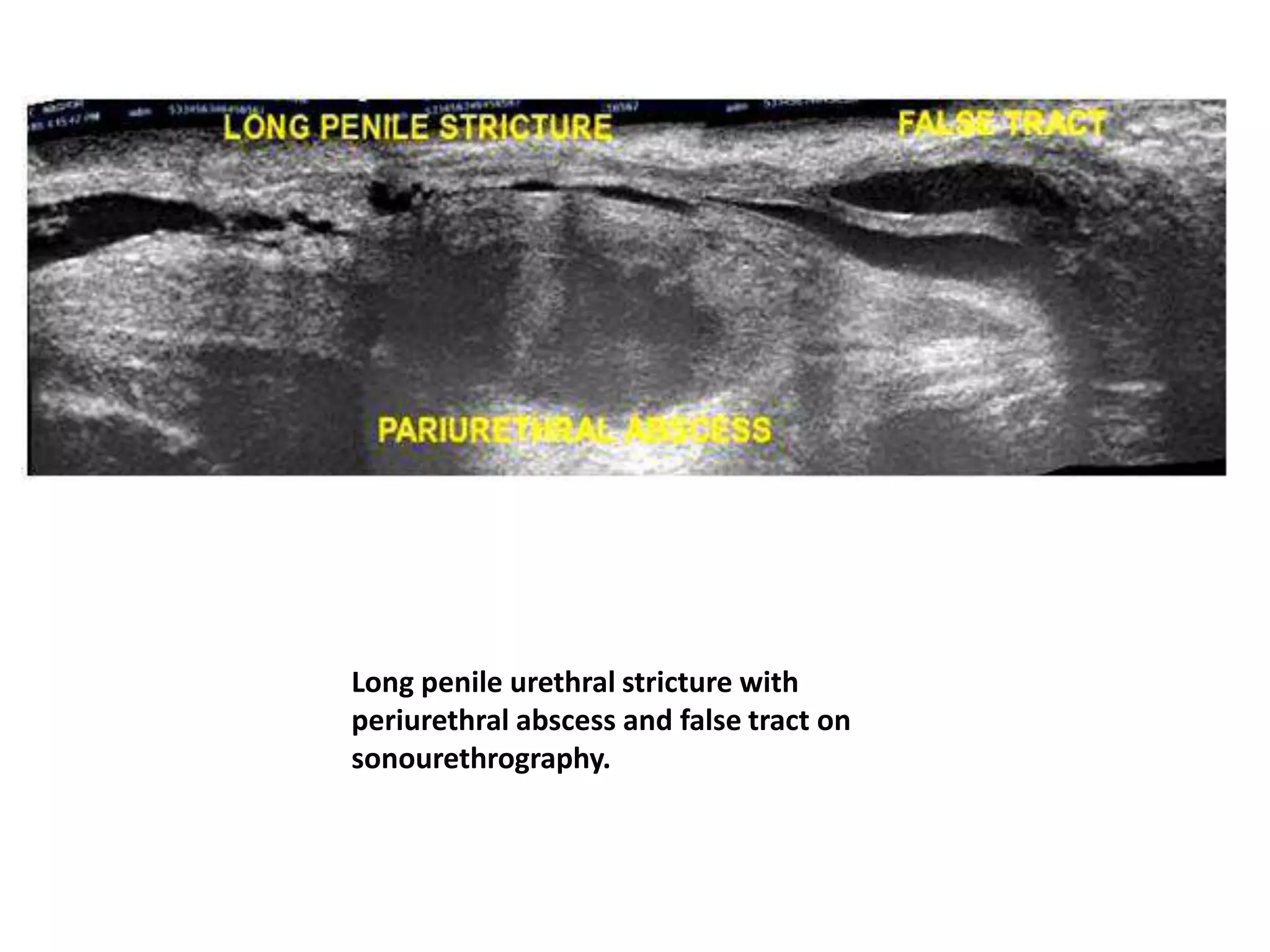 Long penile urethral stricture with
periurethral abscess and false tract on
sonourethrography.
 