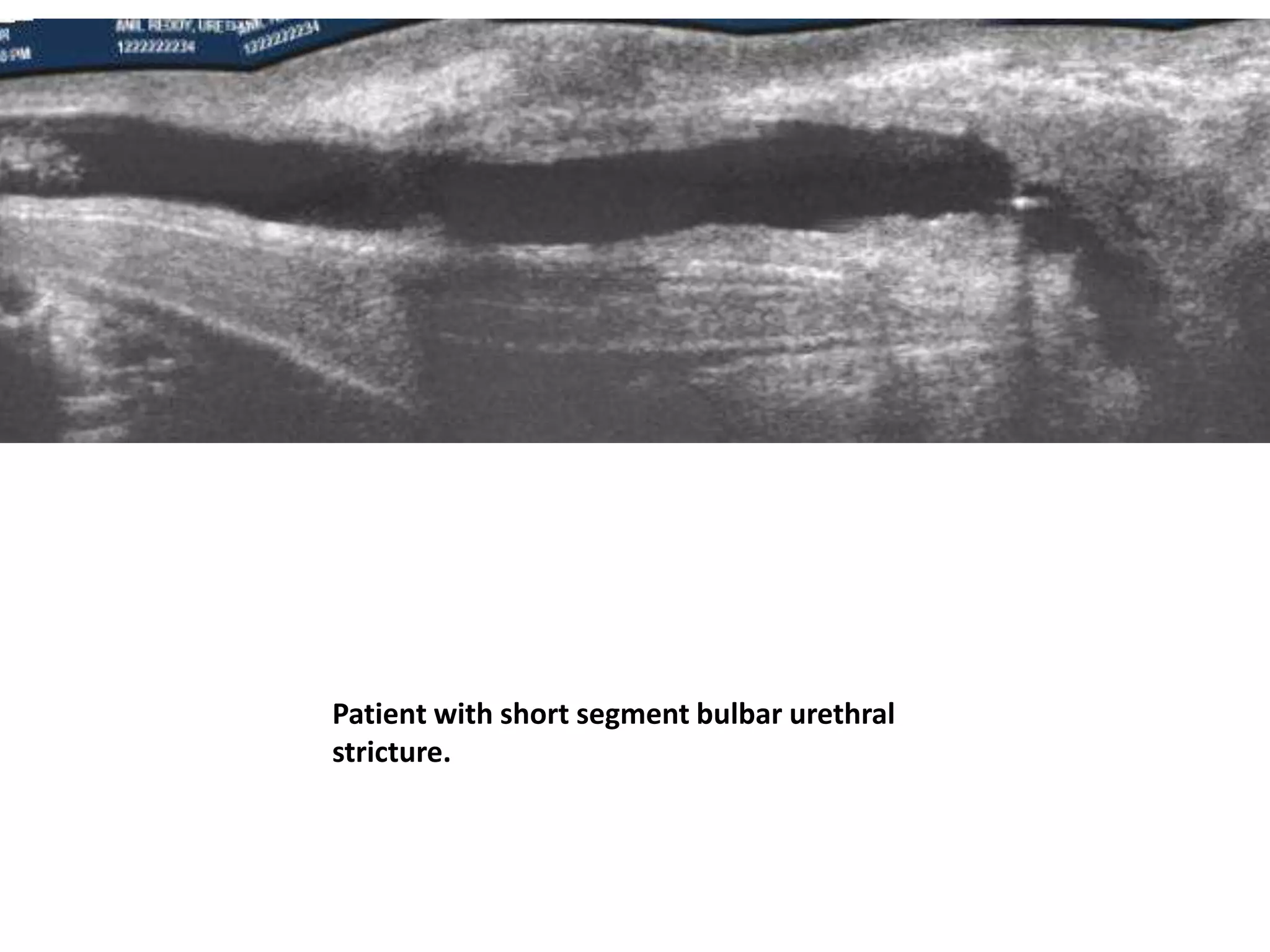 Patient with short segment bulbar urethral
stricture.
 
