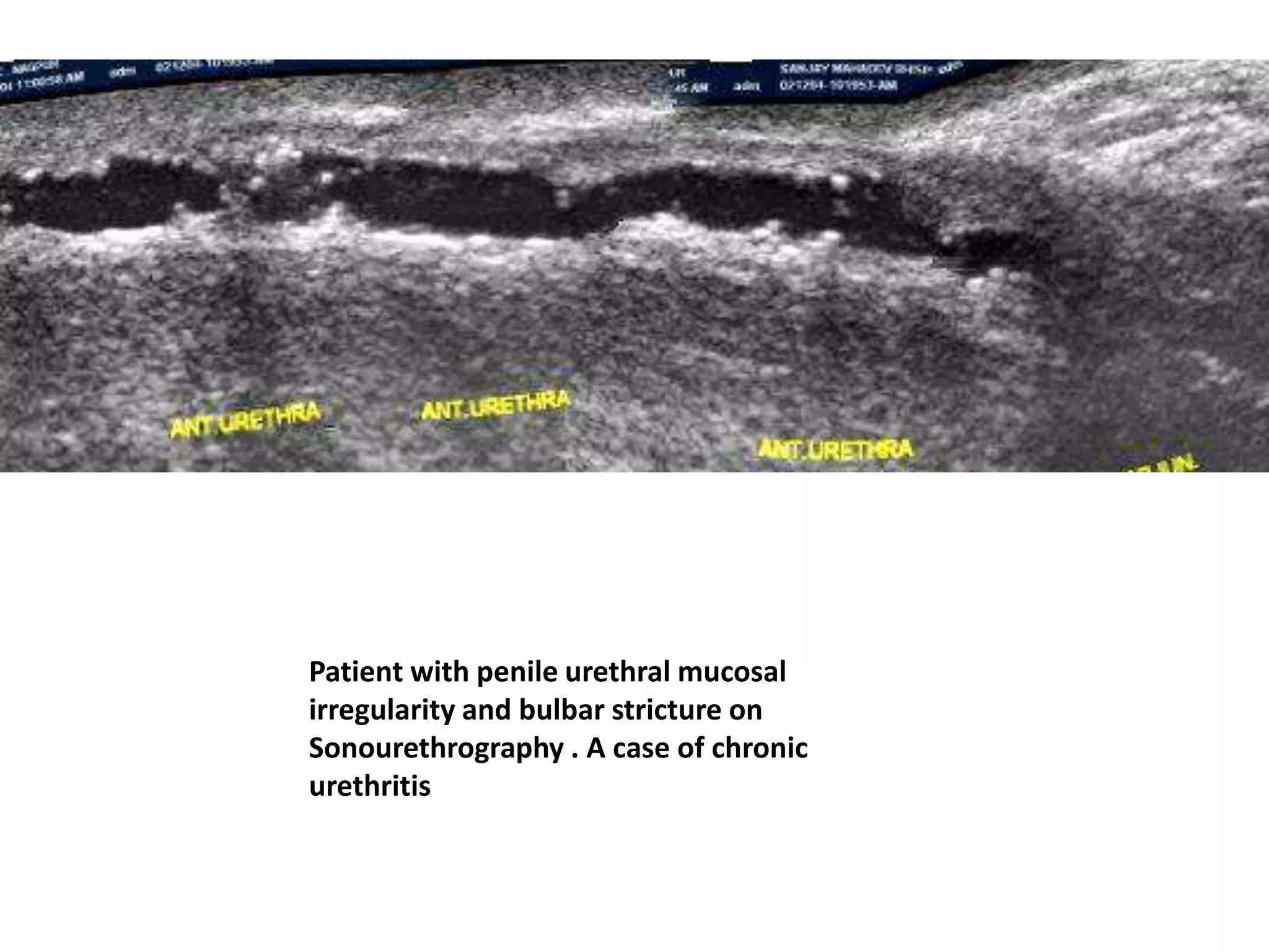 Patient with penile urethral mucosal
irregularity and bulbar stricture on
Sonourethrography . A case of chronic
urethritis
 