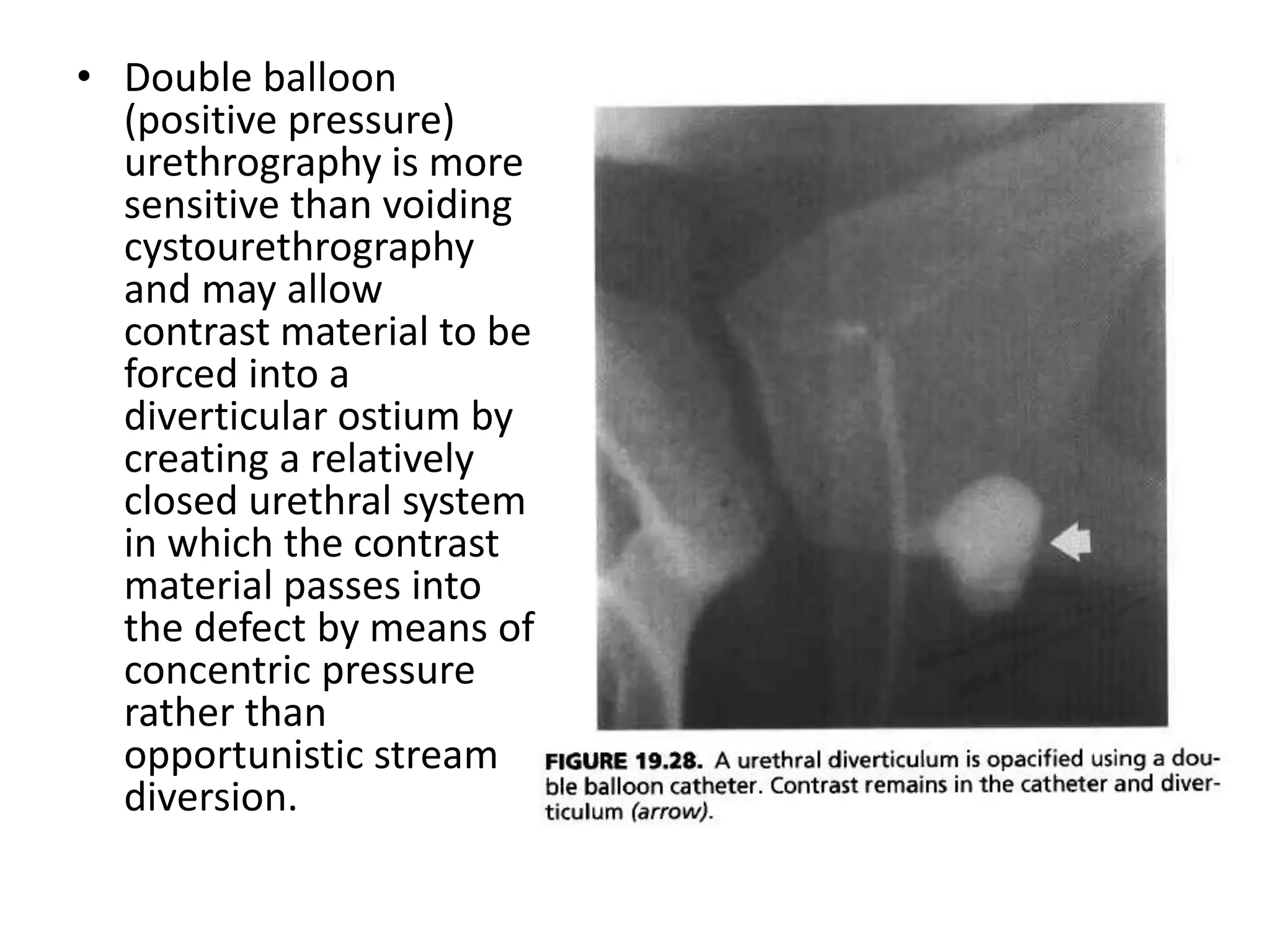 • Double balloon
(positive pressure)
urethrography is more
sensitive than voiding
cystourethrography
and may allow
contrast material to be
forced into a
diverticular ostium by
creating a relatively
closed urethral system
in which the contrast
material passes into
the defect by means of
concentric pressure
rather than
opportunistic stream
diversion.
 