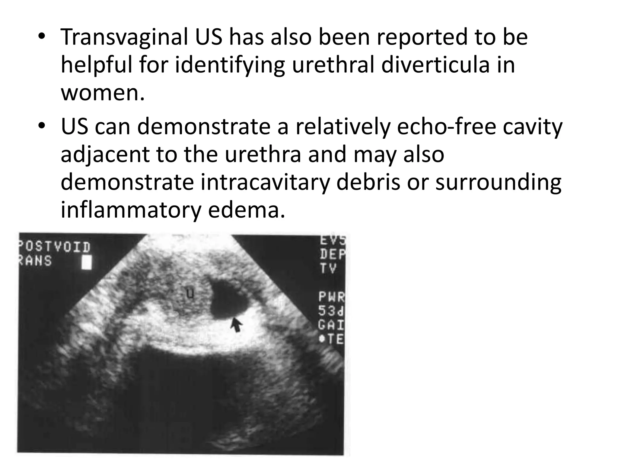 • Transvaginal US has also been reported to be
helpful for identifying urethral diverticula in
women.
• US can demonstrate a relatively echo-free cavity
adjacent to the urethra and may also
demonstrate intracavitary debris or surrounding
inflammatory edema.
 
