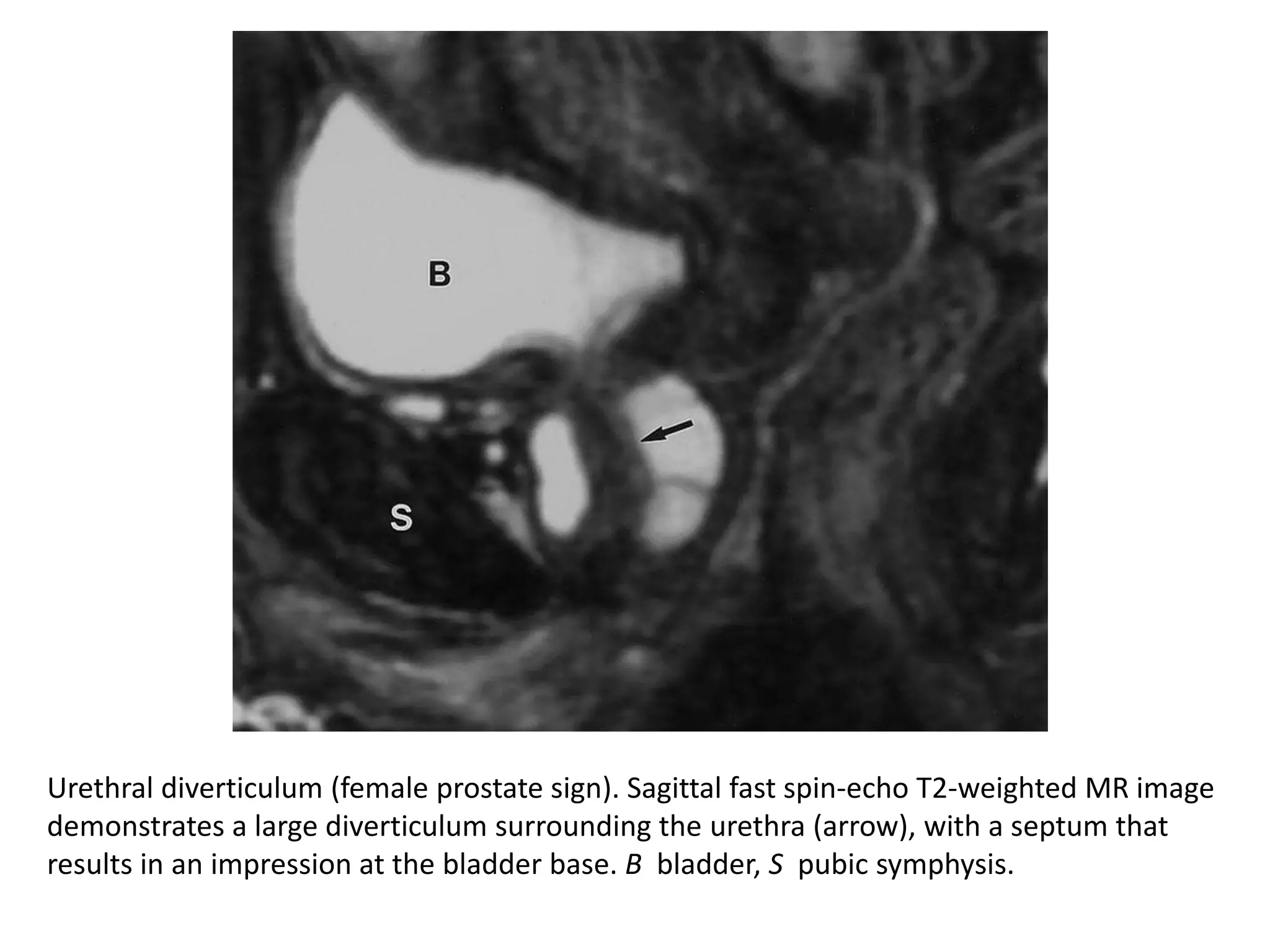 Urethral diverticulum (female prostate sign). Sagittal fast spin-echo T2-weighted MR image
demonstrates a large diverticulum surrounding the urethra (arrow), with a septum that
results in an impression at the bladder base. B bladder, S pubic symphysis.
 