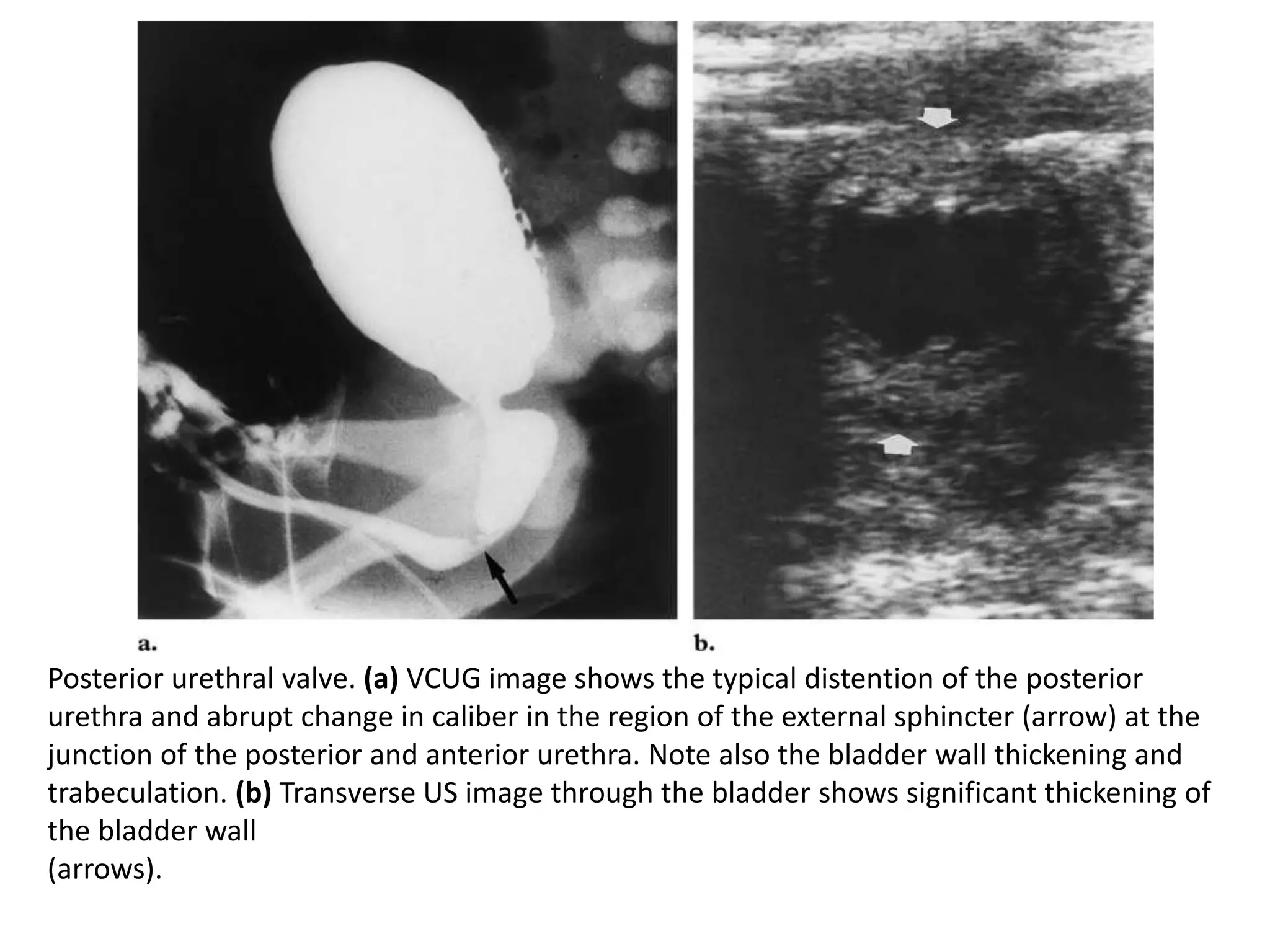 Posterior urethral valve. (a) VCUG image shows the typical distention of the posterior
urethra and abrupt change in caliber in the region of the external sphincter (arrow) at the
junction of the posterior and anterior urethra. Note also the bladder wall thickening and
trabeculation. (b) Transverse US image through the bladder shows significant thickening of
the bladder wall
(arrows).
 