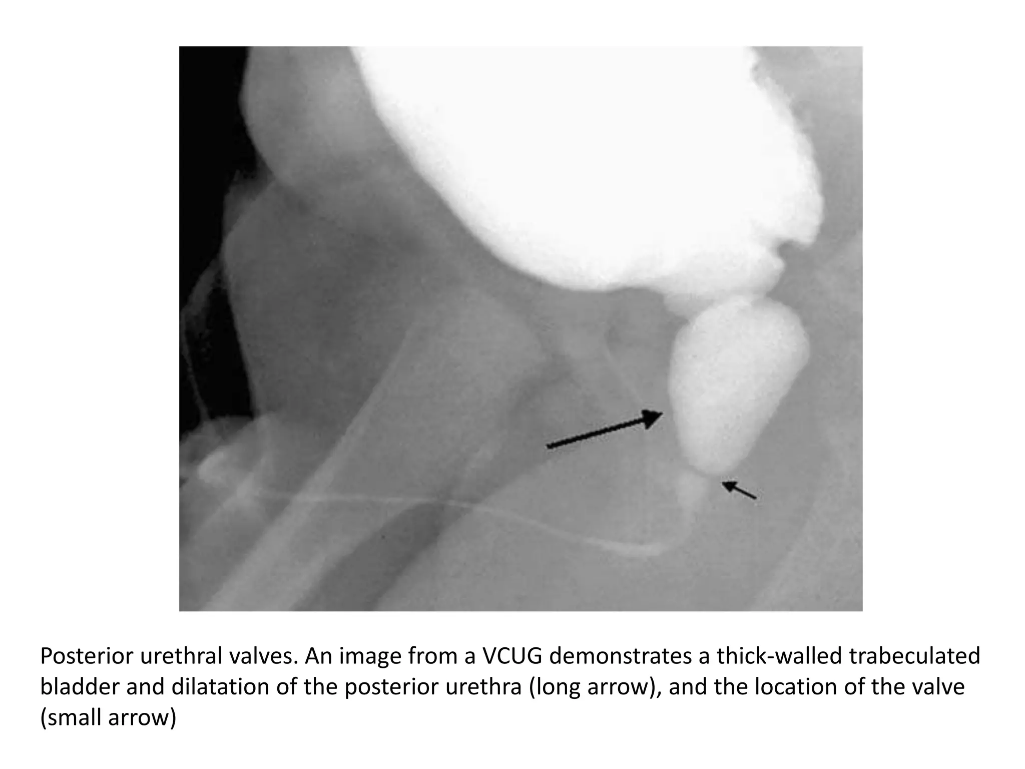 Posterior urethral valves. An image from a VCUG demonstrates a thick-walled trabeculated
bladder and dilatation of the posterior urethra (long arrow), and the location of the valve
(small arrow)
 