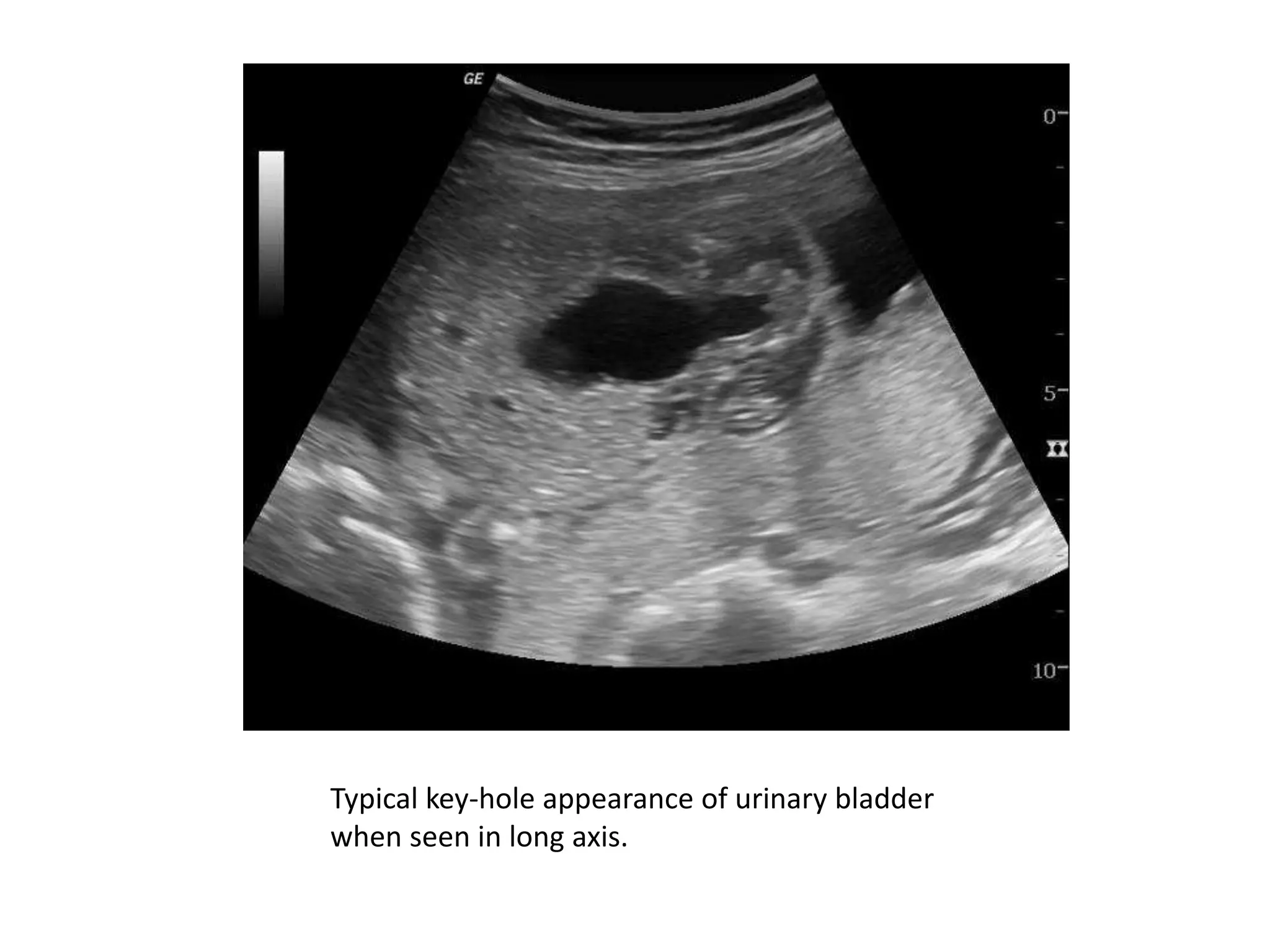 Typical key-hole appearance of urinary bladder
when seen in long axis.
 