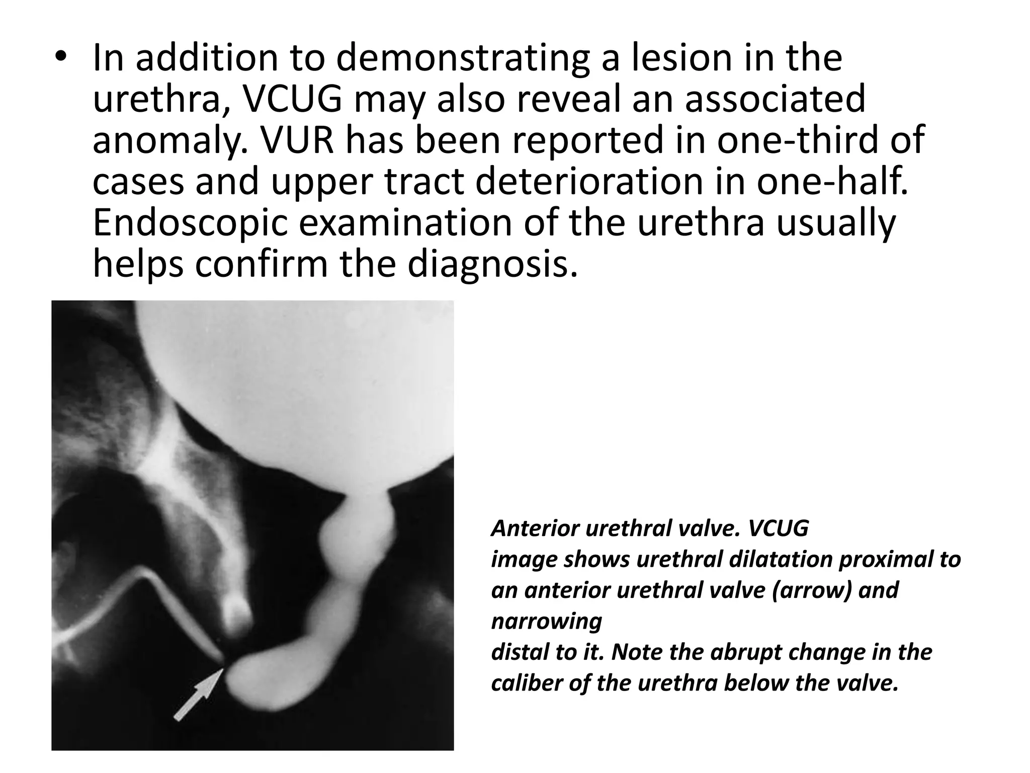 • In addition to demonstrating a lesion in the
urethra, VCUG may also reveal an associated
anomaly. VUR has been reported in one-third of
cases and upper tract deterioration in one-half.
Endoscopic examination of the urethra usually
helps confirm the diagnosis.
Anterior urethral valve. VCUG
image shows urethral dilatation proximal to
an anterior urethral valve (arrow) and
narrowing
distal to it. Note the abrupt change in the
caliber of the urethra below the valve.
 