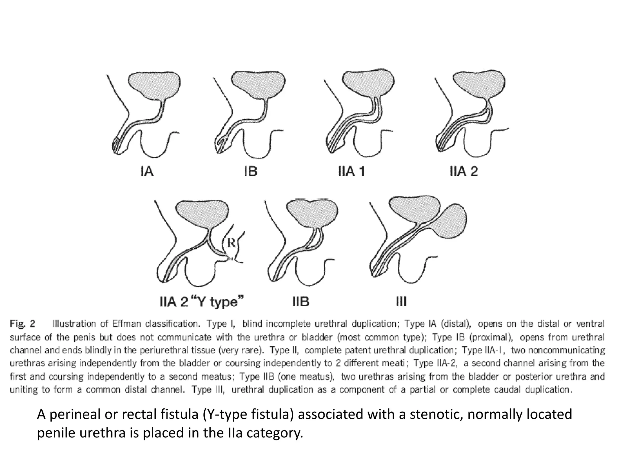 A perineal or rectal fistula (Y-type fistula) associated with a stenotic, normally located
penile urethra is placed in the IIa category.
 