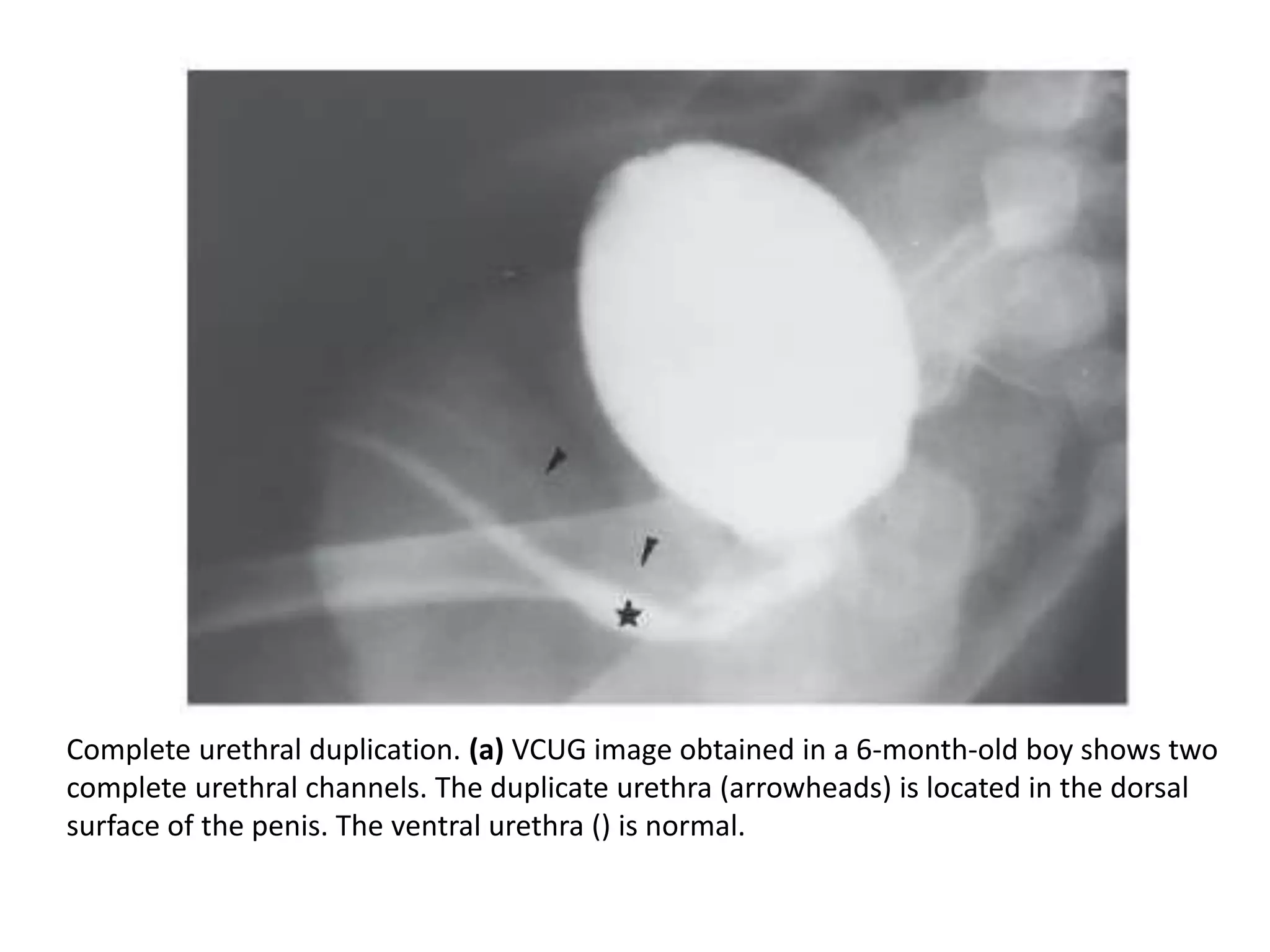 Complete urethral duplication. (a) VCUG image obtained in a 6-month-old boy shows two
complete urethral channels. The duplicate urethra (arrowheads) is located in the dorsal
surface of the penis. The ventral urethra () is normal.
 