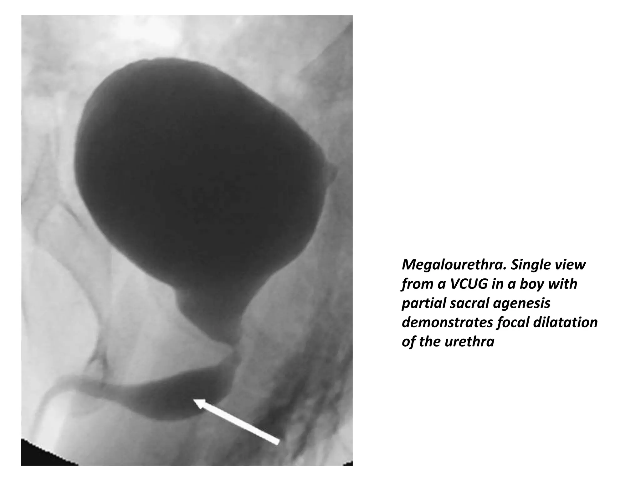 Megalourethra. Single view
from a VCUG in a boy with
partial sacral agenesis
demonstrates focal dilatation
of the urethra
 