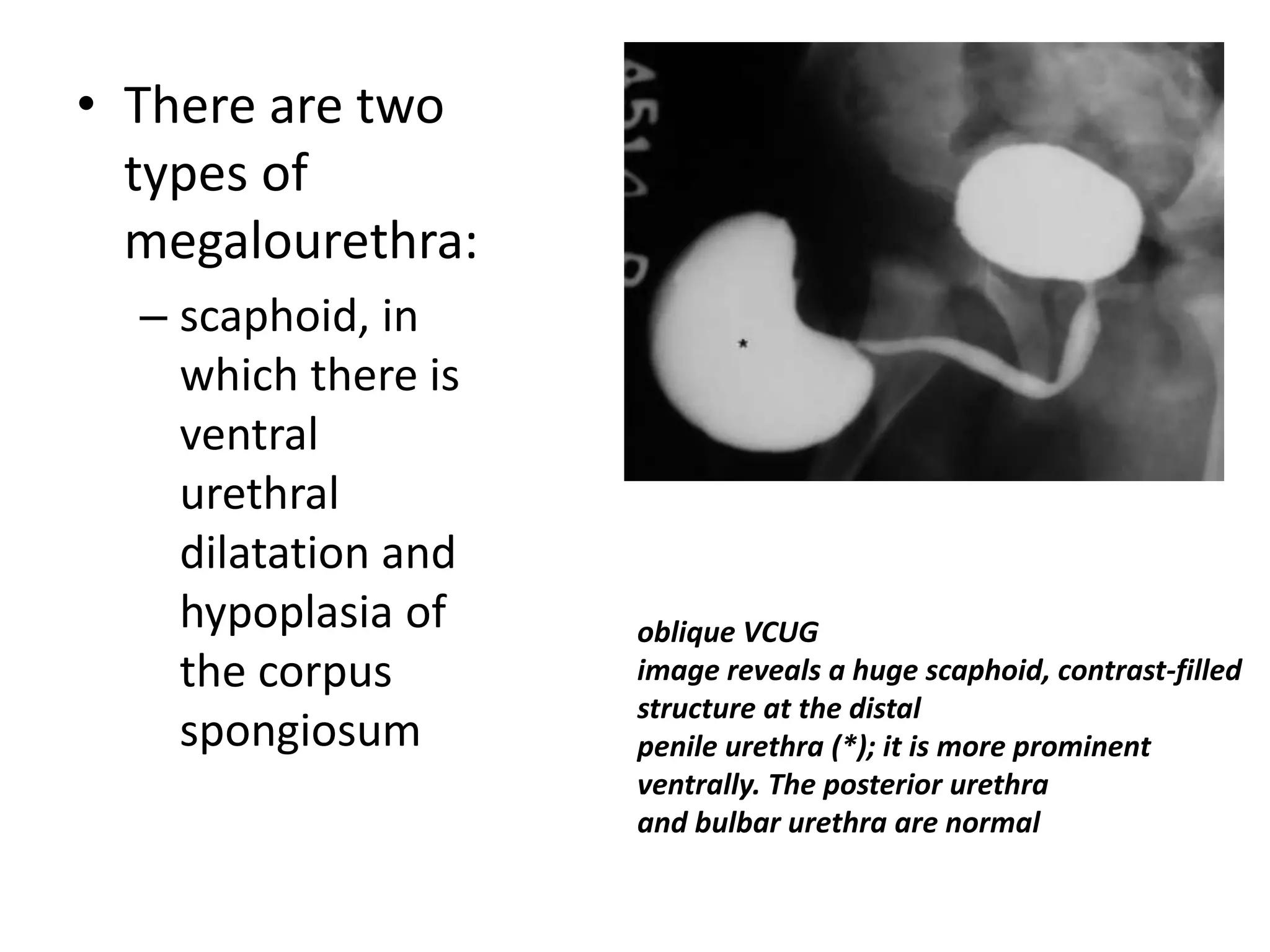 • There are two
types of
megalourethra:
– scaphoid, in
which there is
ventral
urethral
dilatation and
hypoplasia of
the corpus
spongiosum
oblique VCUG
image reveals a huge scaphoid, contrast-filled
structure at the distal
penile urethra (*); it is more prominent
ventrally. The posterior urethra
and bulbar urethra are normal
 