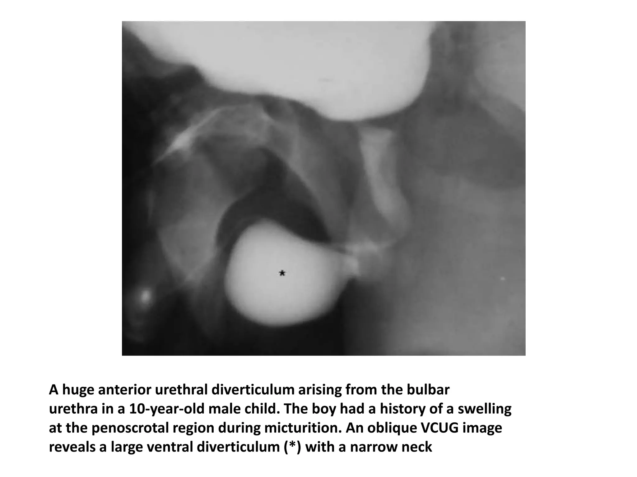 A huge anterior urethral diverticulum arising from the bulbar
urethra in a 10-year-old male child. The boy had a history of a swelling
at the penoscrotal region during micturition. An oblique VCUG image
reveals a large ventral diverticulum (*) with a narrow neck
 