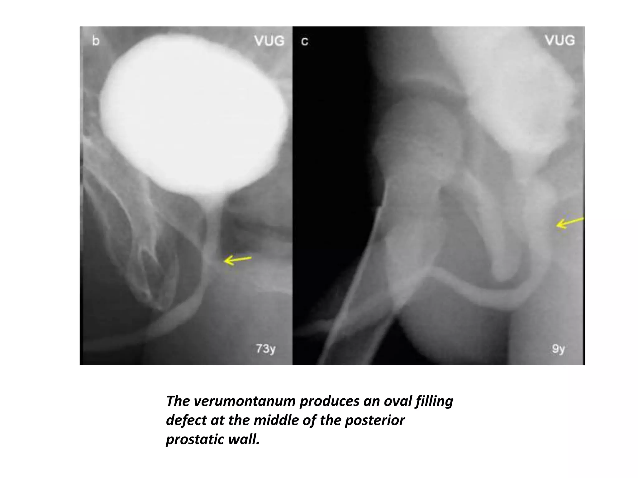 The verumontanum produces an oval filling
defect at the middle of the posterior
prostatic wall.
 