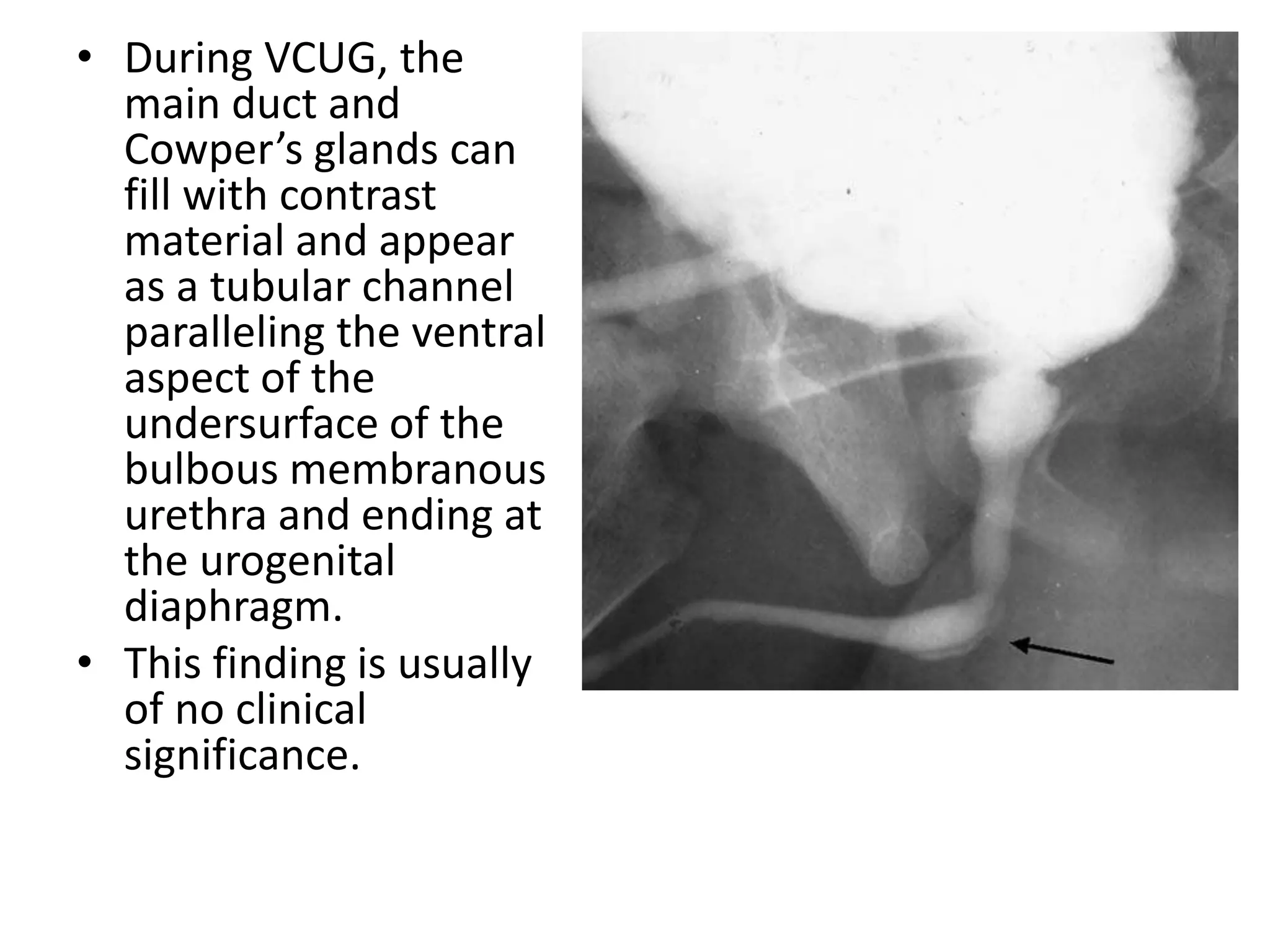 • During VCUG, the
main duct and
Cowper’s glands can
fill with contrast
material and appear
as a tubular channel
paralleling the ventral
aspect of the
undersurface of the
bulbous membranous
urethra and ending at
the urogenital
diaphragm.
• This finding is usually
of no clinical
significance.
 