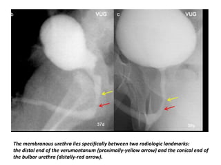 The membranous urethra lies specifically between two radiologic landmarks:
the distal end of the verumontanum (proximally-yellow arrow) and the conical end of
the bulbar urethra (distally-red arrow).
 