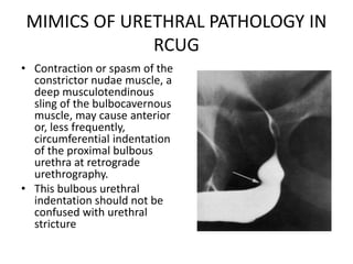 MIMICS OF URETHRAL PATHOLOGY IN
RCUG
• Contraction or spasm of the
constrictor nudae muscle, a
deep musculotendinous
sling of the bulbocavernous
muscle, may cause anterior
or, less frequently,
circumferential indentation
of the proximal bulbous
urethra at retrograde
urethrography.
• This bulbous urethral
indentation should not be
confused with urethral
stricture
 