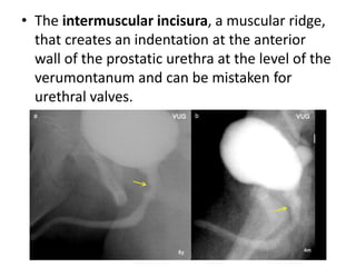 • The intermuscular incisura, a muscular ridge,
that creates an indentation at the anterior
wall of the prostatic urethra at the level of the
verumontanum and can be mistaken for
urethral valves.
 