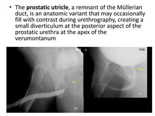 • The prostatic utricle, a remnant of the Müllerian
duct, is an anatomic variant that may occasionally
fill with contrast during urethrography, creating a
small diverticulum at the posterior aspect of the
prostatic urethra at the apex of the
verumontanum
 