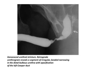 Gonococcal urethral stricture. Retrograde
urethrogram reveals a segment of irregular, beaded narrowing
in the distal bulbous urethra with opacification
of the left Cowper duct
 