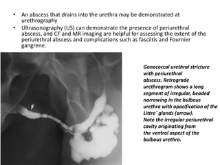 • An abscess that drains into the urethra may be demonstrated at
urethrography
• Ultrasonography (US) can demonstrate the presence of periurethral
abscess, and CT and MR imaging are helpful for assessing the extent of the
periurethral abscess and complications such as fasciitis and Fournier
gangrene.
Gonococcal urethral stricture
with periurethral
abscess. Retrograde
urethrogram shows a long
segment of irregular, beaded
narrowing in the bulbous
urethra with opacification of the
Littre´ glands (arrow).
Note the irregular periurethral
cavity originating from
the ventral aspect of the
bulbous urethra.
 