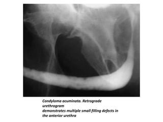 Condyloma acuminata. Retrograde
urethrogram
demonstrates multiple small filling defects in
the anterior urethra
 