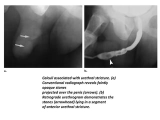 Calculi associated with urethral stricture. (a)
Conventional radiograph reveals faintly
opaque stones
projected over the penis (arrows). (b)
Retrograde urethrogram demonstrates the
stones (arrowhead) lying in a segment
of anterior urethral stricture.
 