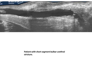 Patient with short segment bulbar urethral
stricture.
 