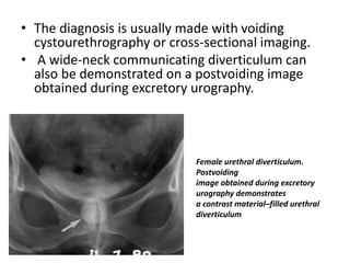 • The diagnosis is usually made with voiding
cystourethrography or cross-sectional imaging.
• A wide-neck communicating diverticulum can
also be demonstrated on a postvoiding image
obtained during excretory urography.
Female urethral diverticulum.
Postvoiding
image obtained during excretory
urography demonstrates
a contrast material–filled urethral
diverticulum
 