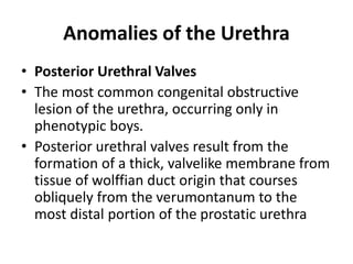 Anomalies of the Urethra
• Posterior Urethral Valves
• The most common congenital obstructive
lesion of the urethra, occurring only in
phenotypic boys.
• Posterior urethral valves result from the
formation of a thick, valvelike membrane from
tissue of wolffian duct origin that courses
obliquely from the verumontanum to the
most distal portion of the prostatic urethra
 