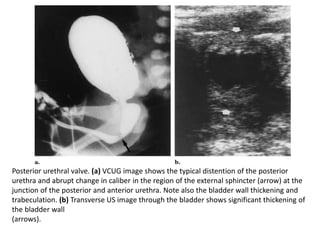 Posterior urethral valve. (a) VCUG image shows the typical distention of the posterior
urethra and abrupt change in caliber in the region of the external sphincter (arrow) at the
junction of the posterior and anterior urethra. Note also the bladder wall thickening and
trabeculation. (b) Transverse US image through the bladder shows significant thickening of
the bladder wall
(arrows).
 