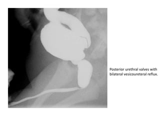 Posterior urethral valves with
bilateral vesicoureteral reflux.
 