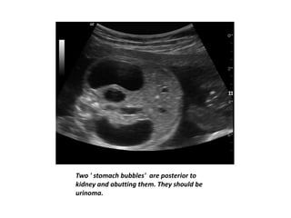 Two ' stomach bubbles' are posterior to
kidney and abutting them. They should be
urinoma.
 