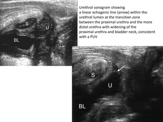 Urethral sonogram showing
a linear echogenic line (arrow) within the
urethral lumen at the transition zone
between the proximal urethra and the more
distal urethra with widening of the
proximal urethra and bladder neck, consistent
with a PUV
 
