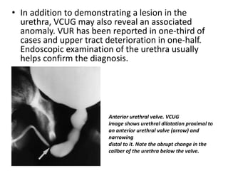• In addition to demonstrating a lesion in the
urethra, VCUG may also reveal an associated
anomaly. VUR has been reported in one-third of
cases and upper tract deterioration in one-half.
Endoscopic examination of the urethra usually
helps confirm the diagnosis.
Anterior urethral valve. VCUG
image shows urethral dilatation proximal to
an anterior urethral valve (arrow) and
narrowing
distal to it. Note the abrupt change in the
caliber of the urethra below the valve.
 