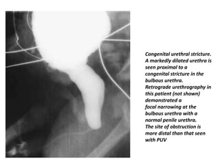 Congenital urethral stricture.
A markedly dilated urethra is
seen proximal to a
congenital stricture in the
bulbous urethra.
Retrograde urethrography in
this patient (not shown)
demonstrated a
focal narrowing at the
bulbous urethra with a
normal penile urethra.
The site of obstruction is
more distal than that seen
with PUV
 