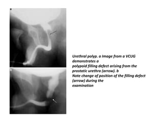 Urethral polyp. a Image from a VCUG
demonstrates a
polypoid filling defect arising from the
prostatic urethra (arrow). b
Note change of position of the filling defect
(arrow) during the
examination
 