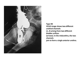 Type IIB
VCUG image shows two different
urethral channels
(1, 2) arising from two different
bladder orifices
(arrows). In the midurethra, the two
channels
join to form a single anterior urethra.
 
