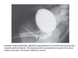 Complete urethral duplication. (a) VCUG image obtained in a 6-month-old boy shows two
complete urethral channels. The duplicate urethra (arrowheads) is located in the dorsal
surface of the penis. The ventral urethra () is normal.
 