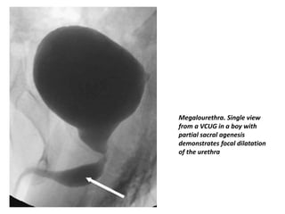 Megalourethra. Single view
from a VCUG in a boy with
partial sacral agenesis
demonstrates focal dilatation
of the urethra
 