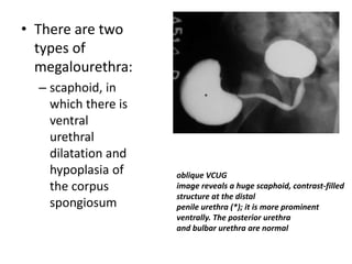 • There are two
types of
megalourethra:
– scaphoid, in
which there is
ventral
urethral
dilatation and
hypoplasia of
the corpus
spongiosum
oblique VCUG
image reveals a huge scaphoid, contrast-filled
structure at the distal
penile urethra (*); it is more prominent
ventrally. The posterior urethra
and bulbar urethra are normal
 