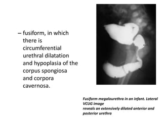 – fusiform, in which
there is
circumferential
urethral dilatation
and hypoplasia of the
corpus spongiosa
and corpora
cavernosa.
Fusiform megalourethra in an infant. Lateral
VCUG image
reveals an extensively dilated anterior and
posterior urethra
 