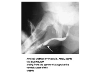 Anterior urethral diverticulum. Arrow points
to a diverticulum
arising from and communicating with the
ventral aspect of the
urethra
 