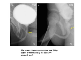 The verumontanum produces an oval filling
defect at the middle of the posterior
prostatic wall.
 