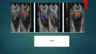 Trus Urology Example Imaging of urinary bladder malignancy | PPTX
