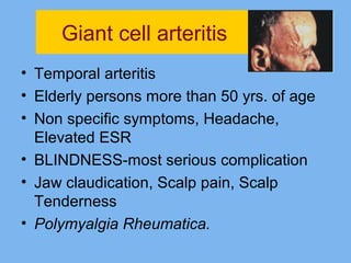 Giant cell arteritis 
• Temporal arteritis 
• Elderly persons more than 50 yrs. of age 
• Non specific symptoms, Headache, 
Elevated ESR 
• BLINDNESS-most serious complication 
• Jaw claudication, Scalp pain, Scalp 
Tenderness 
• Polymyalgia Rheumatica. 
 