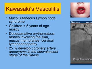 Kawasaki’s Vasculitis 
• MucoCutaneous Lymph node 
syndrome 
• Children < 5 years of age 
mostly 
• Desquamative erythematous 
rashes involving the skin, 
mucus membranes, cervical 
lymphadenopathy 
• 25 % develop coronary artery 
aneurysms in the convalescent 
stage of the illness 
 
