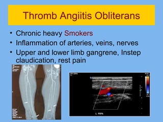 Thromb Angiitis Obliterans 
• Chronic heavy Smokers 
• Inflammation of arteries, veins, nerves 
• Upper and lower limb gangrene, Instep 
claudication, rest pain 
 