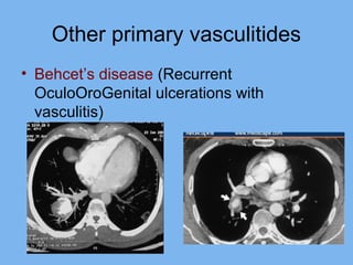 Other primary vasculitides 
• Behcet’s disease (Recurrent 
OculoOroGenital ulcerations with 
vasculitis) 
 