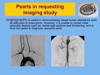 Pearls in requesting 
imaging study 
Angiography is useful in demonstrating vessel lumen alterations such 
as stenoses or aneurysms. However, it is unable to reveal initial 
vasculitic lesions such as vessel wall oedema and thickening, and is 
thus not useful to diagnose vasculitis early. 
 